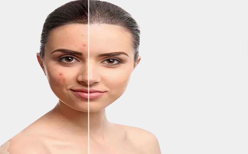 Laser Scar Removal